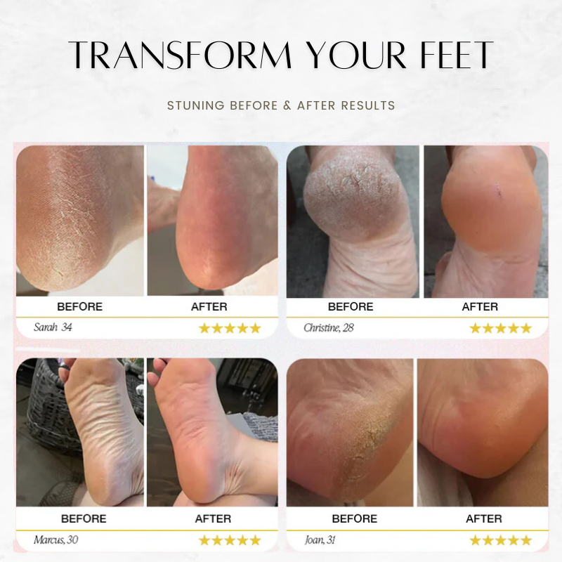 SilkSole™ Effortless Callus Removal at Home