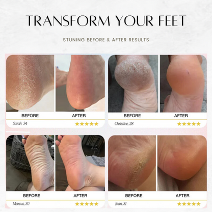 SilkSole - Effortless Callus Removal at Home